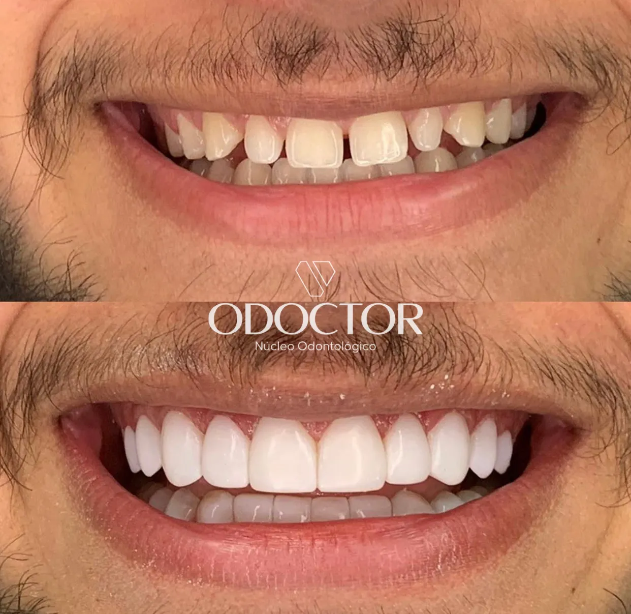 Antes e depois de lentes e facetas na Odoctor