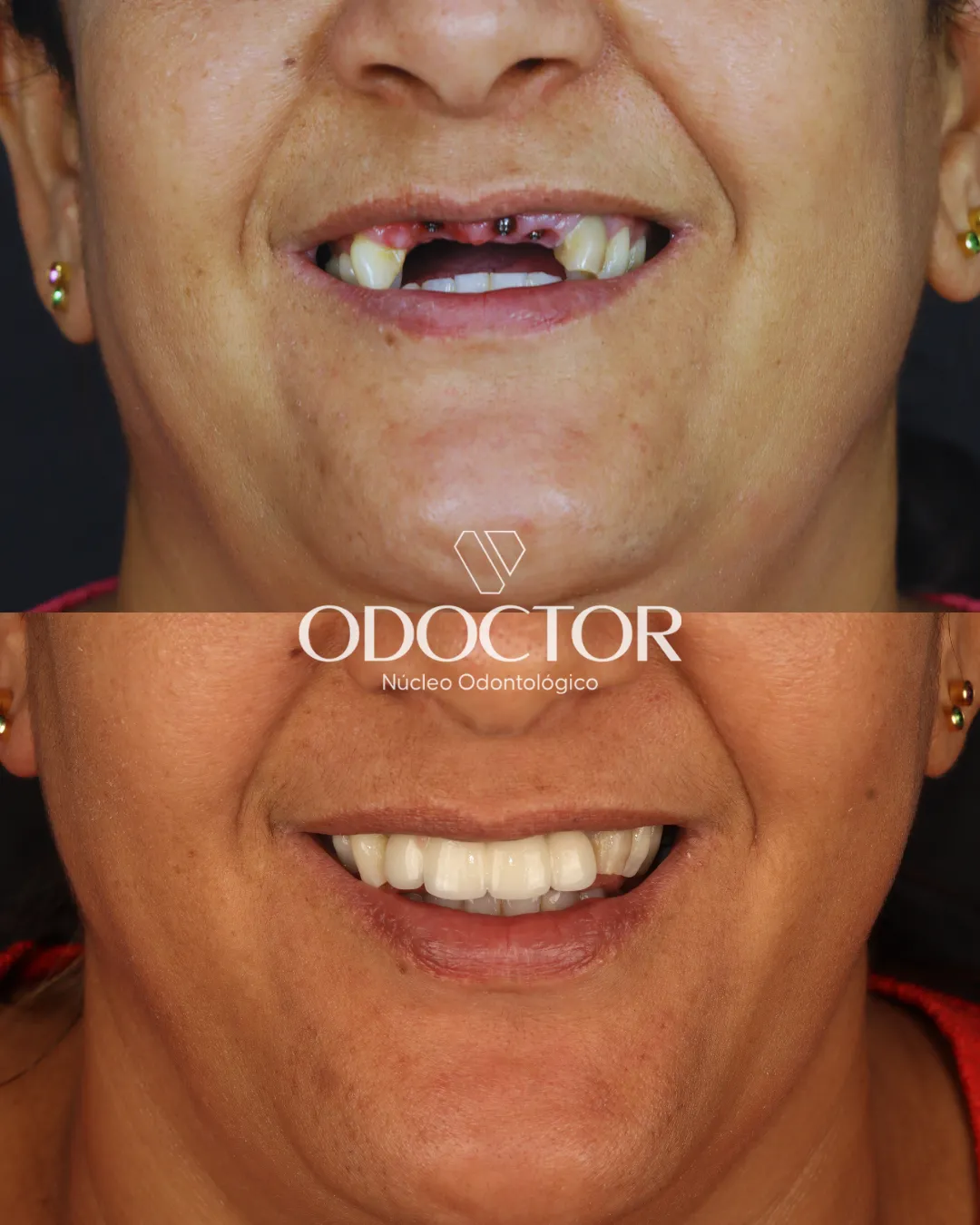 Antes e depois de implantes dentários na Odoctor