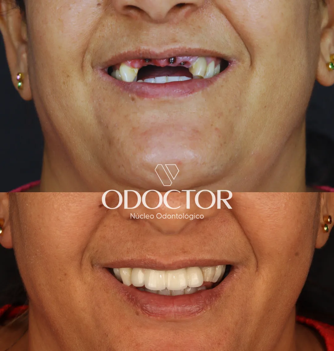 Antes e depois de implantes dentários na Odoctor